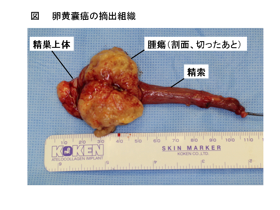 小児の精巣腫瘍 小児泌尿器科の主な疾患 日本小児泌尿器科学会 Japanese Society Of Pediatric Urology